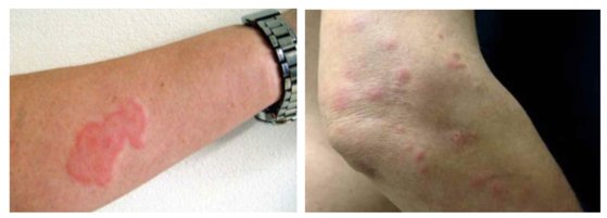 韓国旅行中のトコジラミ対策ガイドKlookブログ