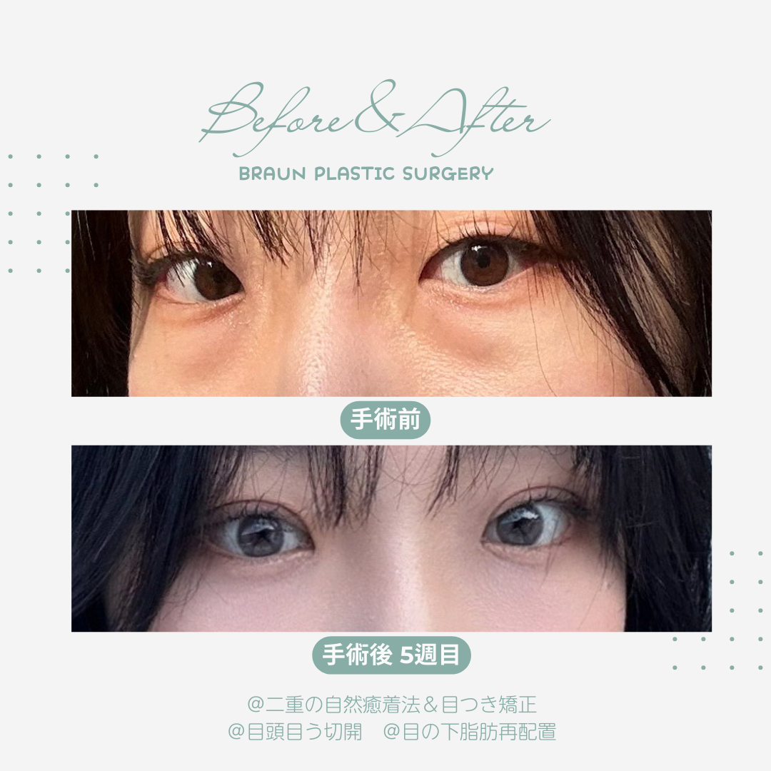 韓国・江南で目の下の脂肪再配置手術 目の下クマ取り 体験談✨