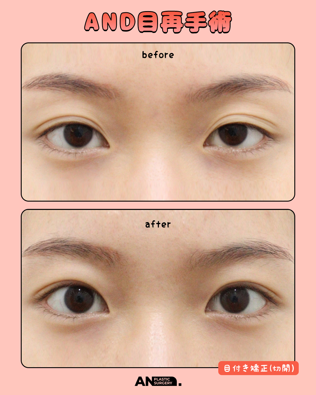 ソウルでクマ取りの脂肪再配置・裏ハムラ法、二重術の手術