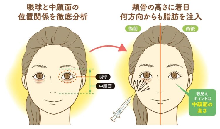 韓国釜山で目の下の切らないクマ取り 裏ハムラ法- プサンJMJ運営の美容情報サイト