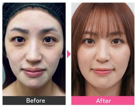 お問い合わせ続出の”クマ取りアートメイク“🐼, 疲れた印象を与えてしまったり、実年齢よりも老けた印象を与えてしまうクマ ,アートメイクで改善しませんか？😊✨, ゴールデンバランスで取り扱いあり！ご予約待ってます🌷,クマ取りアートメイク韓国アートメイク韓国旅行ゴールデンバランスクリニック