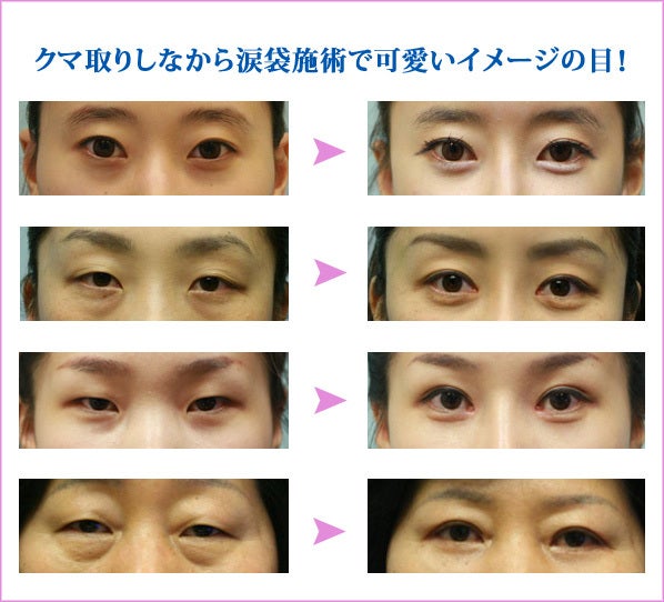 韓国と日本、クマ取り手術はどっちでする？長年のコンプレックスだったクマを改善！クマとり手術について徹底解説 - AYAKOREAエージェント