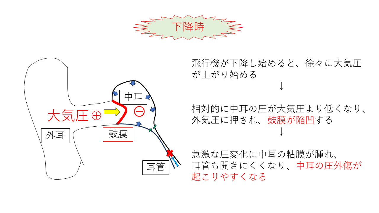 １ 飛行機の降下時に耳が痛くなる「航空性中耳炎」 降下時は耳抜きを