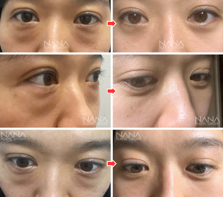 韓国人妻に糸リフト、クマ取り、ヒアルロン酸注射に連れていったら激変!全て見せます