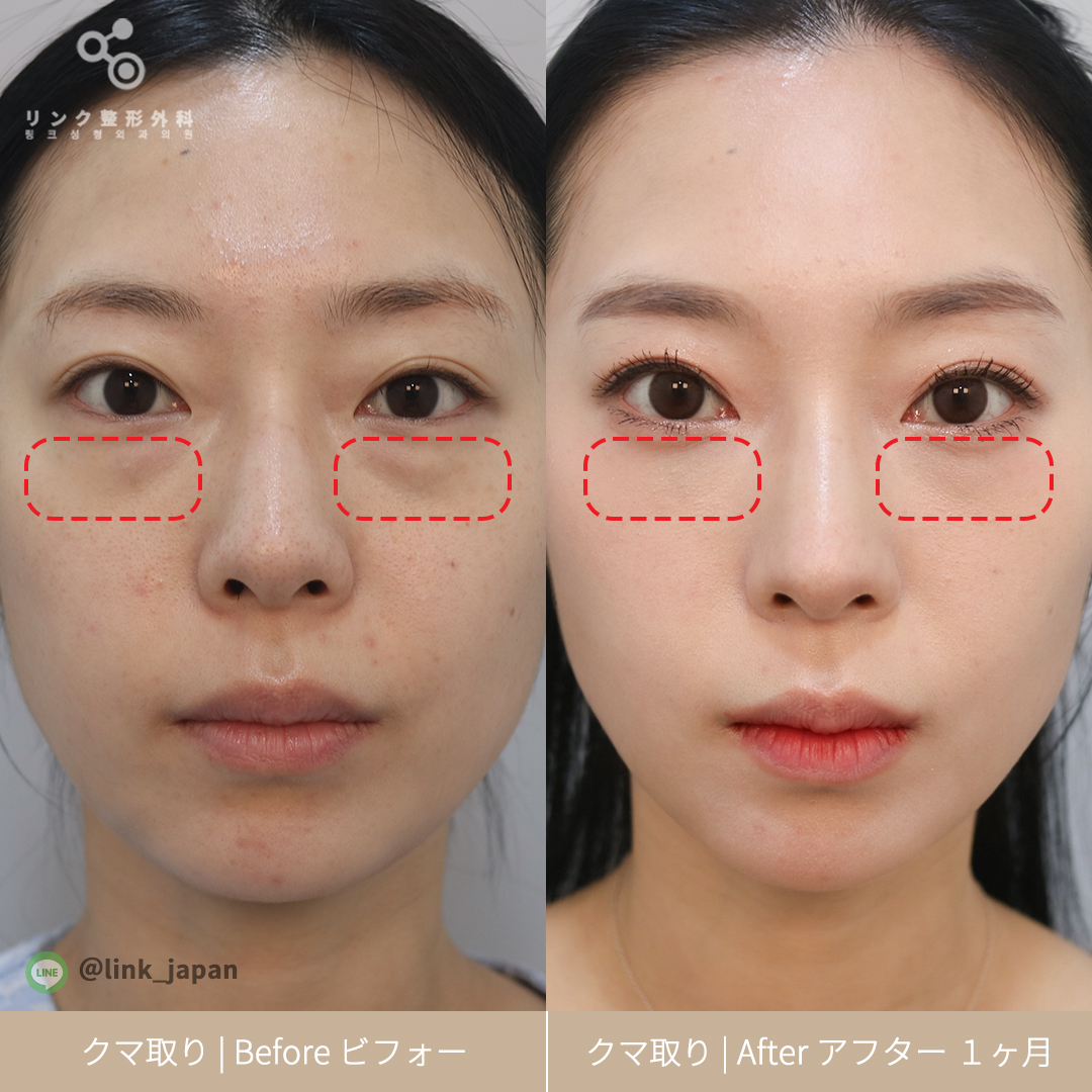 メンズ二重整形、切開法、埋没法、目頭切開、まぶた脂肪取り、エートップ美容整形外科、韓国整形、自然公式 エートップ美容整形外科