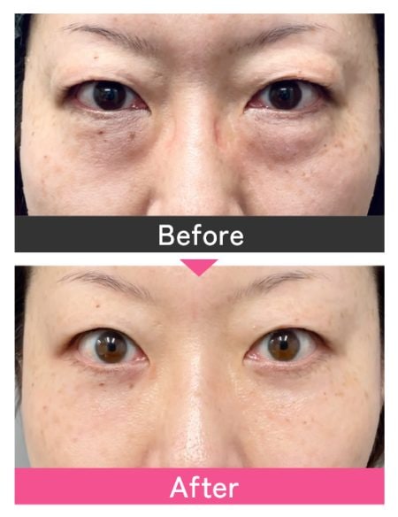 韓国旅行🇰🇷 クマがすごいのでクマ手術してきました