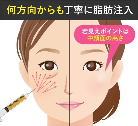 クマ取りは日本と韓国どちらでやるべき