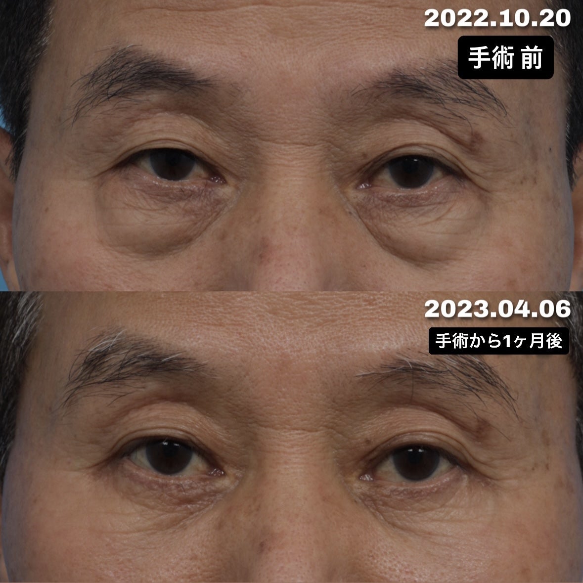 江南 カンナム エリアのクマ取りおすすめ5選！格安・人気のクリニックを紹介wonderkorea