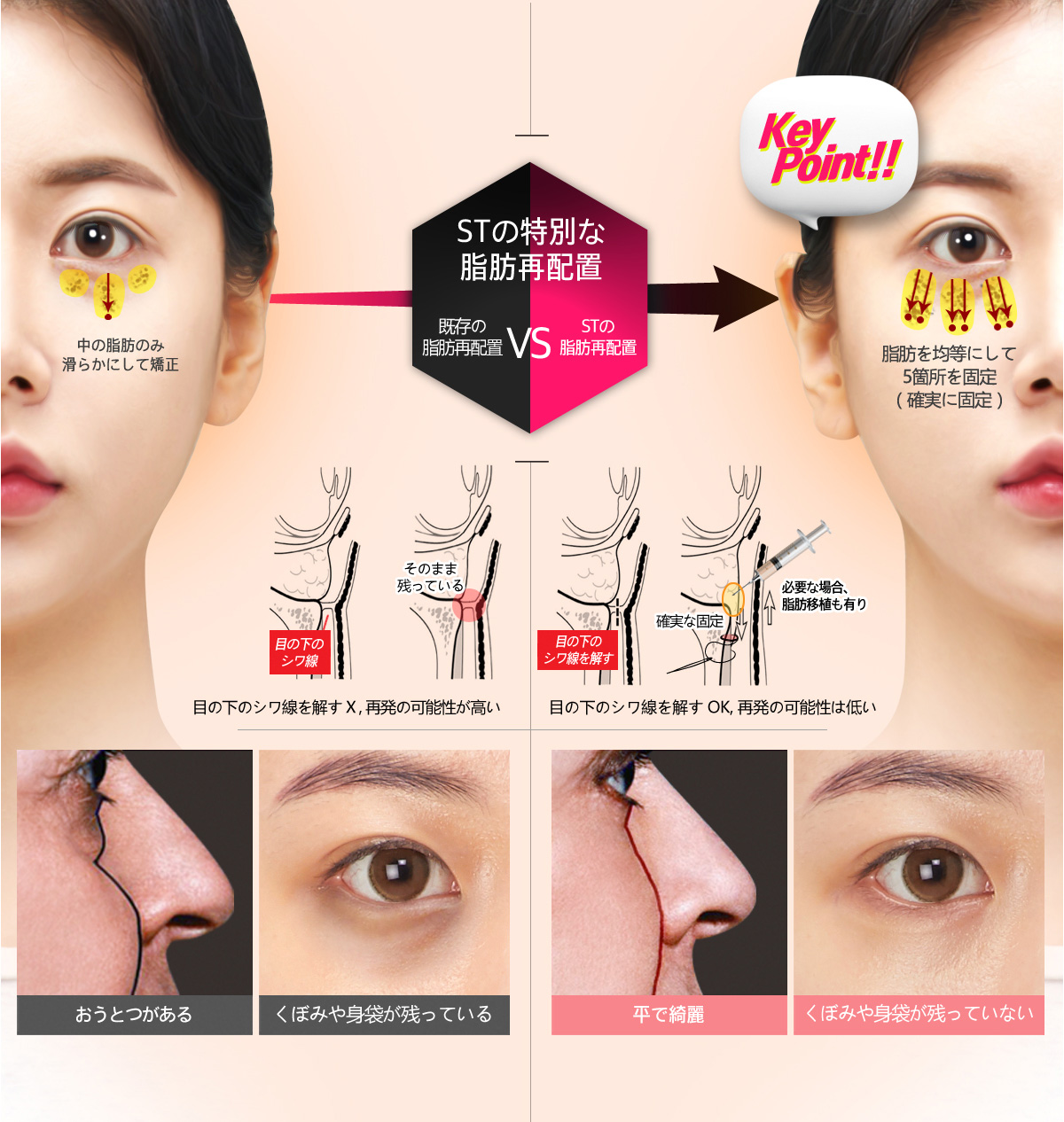 韓国のクマ取りを脂肪注入で再現した「韓流クマ取り」、切開せずに改善するケースもNEWSポストセブン