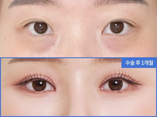 目の下のくまクリニック – 韓国ST美容整形外科