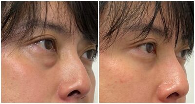 韓国整形 クマ取りはオブジェ整形外科！韓国OBJET美容整形外科