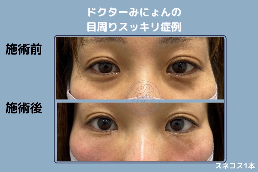 目の下整形 気になる目の下のたるみ・クマ取りについて解説 韓国JAYJUNJAYJUN美容外科・皮膚科