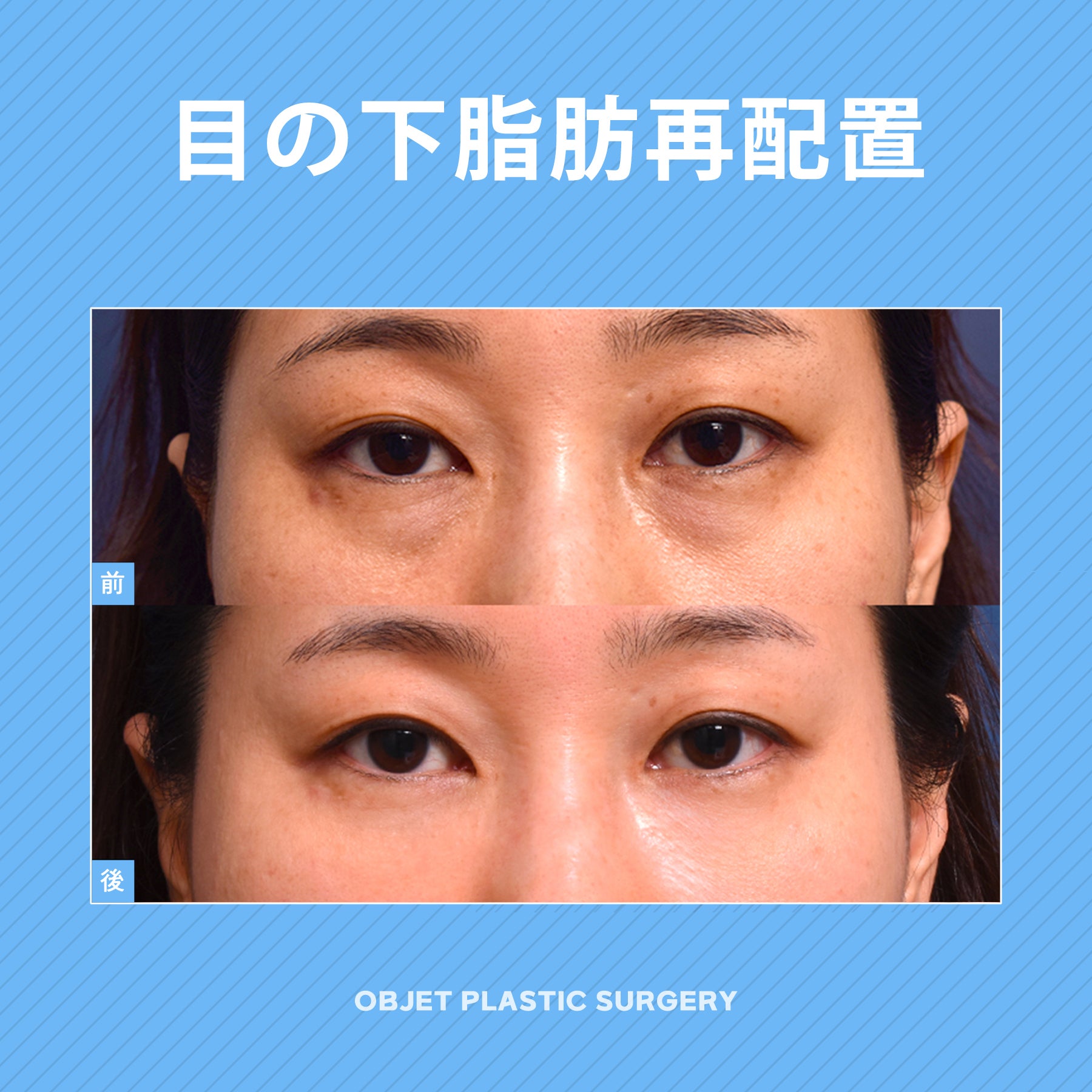 目の下クマ取りしながら涙袋で可愛い目に！！ 韓国整形、韓国美容整形案内会社ナビ韓国整形無料サポートナビコリア韓国整形エージェント・韓国 整形ブログ